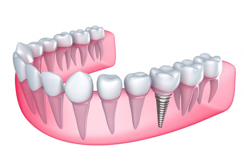 implantaciya-zubov-v-moskve.png